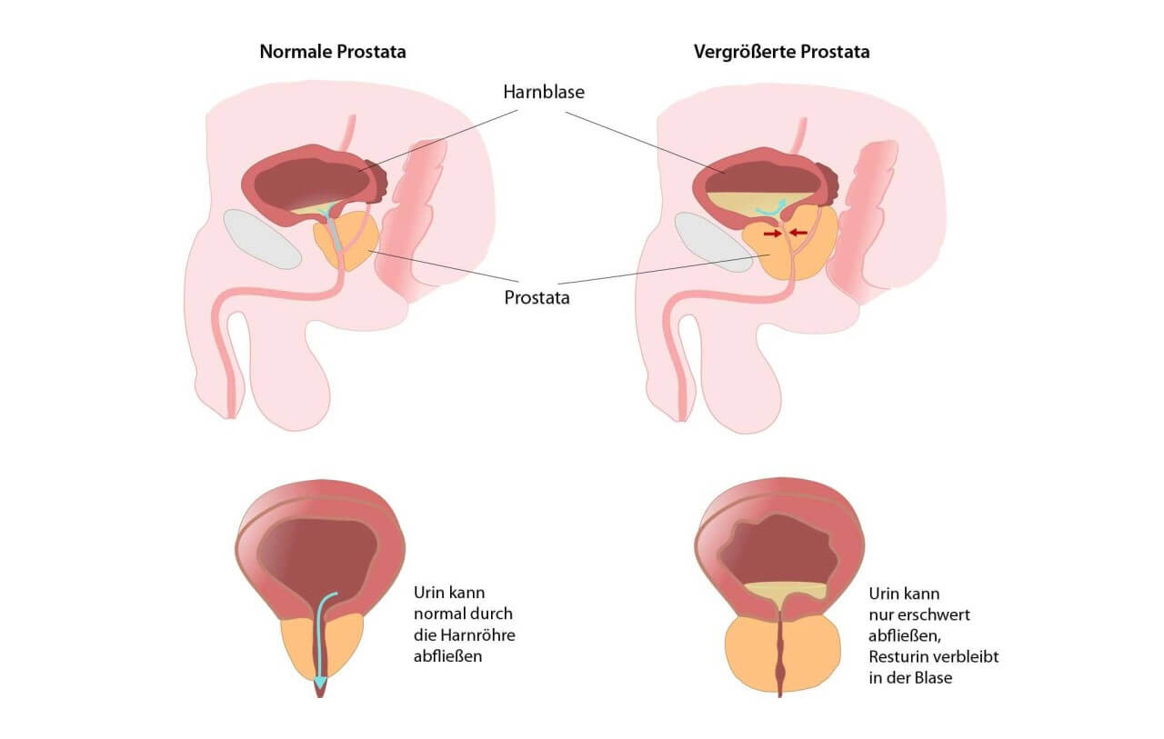 Tamsulosin Nebenwirkungen Impotenz: Vergleich normale und vergrößerte Prostata